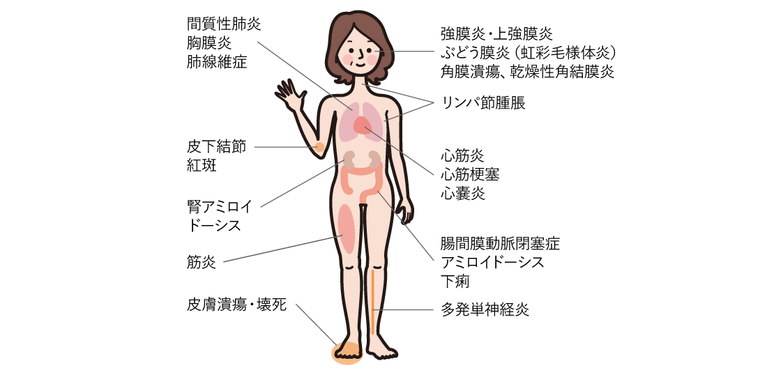 関節リウマチの関節外症状の図